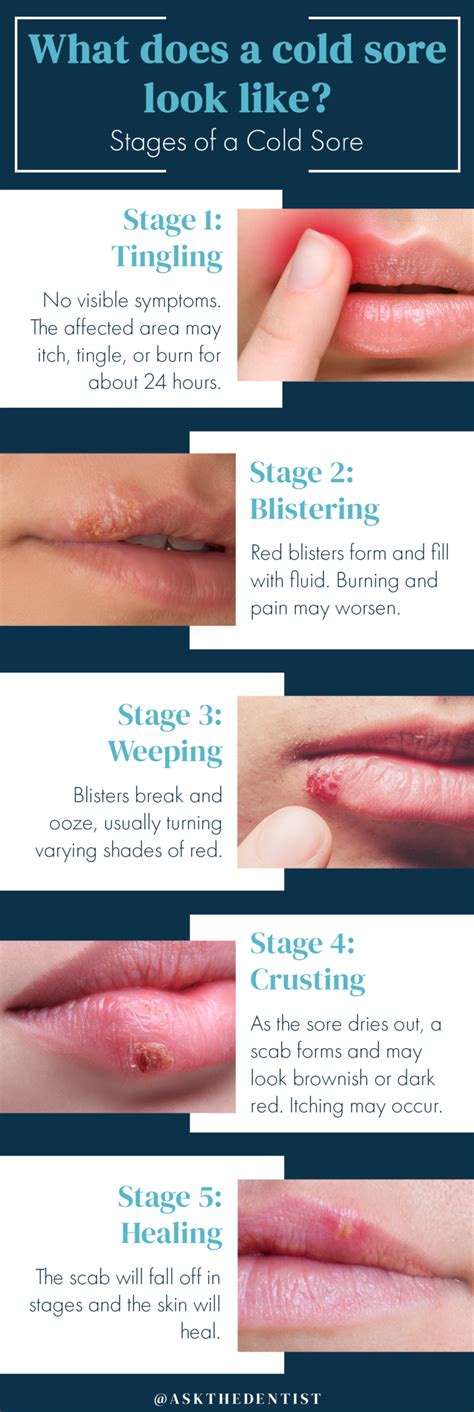 dating cold sores